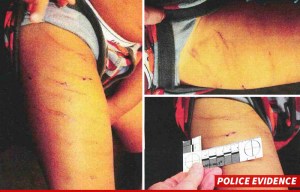 Photos of injuries to Adrian Peterson's son.