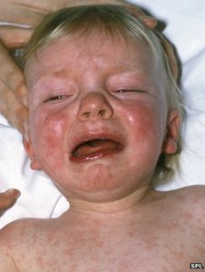_67045568_measles