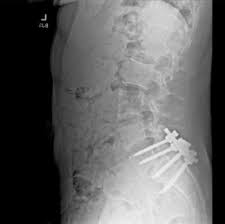 Mangione's back x-ray